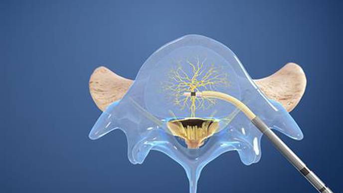 UC San Diego Health Offers New Treatment for Chronic Low Back Pain