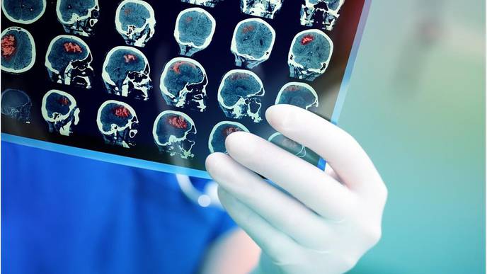 Men & Women May Require Different Brain Tumor Therapy, Study Finds