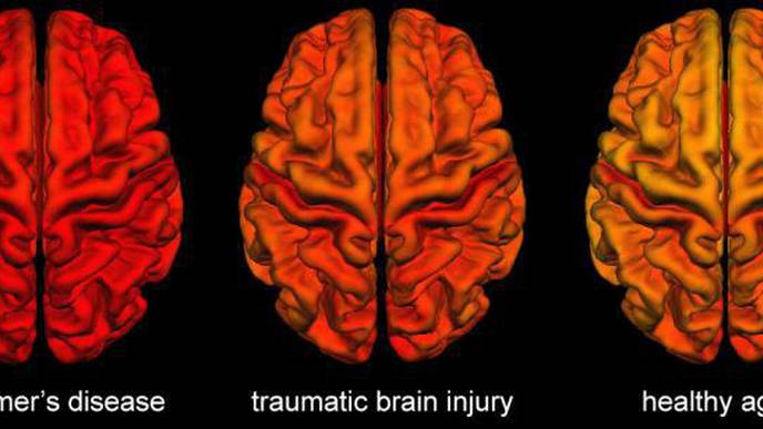 Brain Changes Following Traumatic Brain Injury Share Similarities with Alzheimer’s Disease