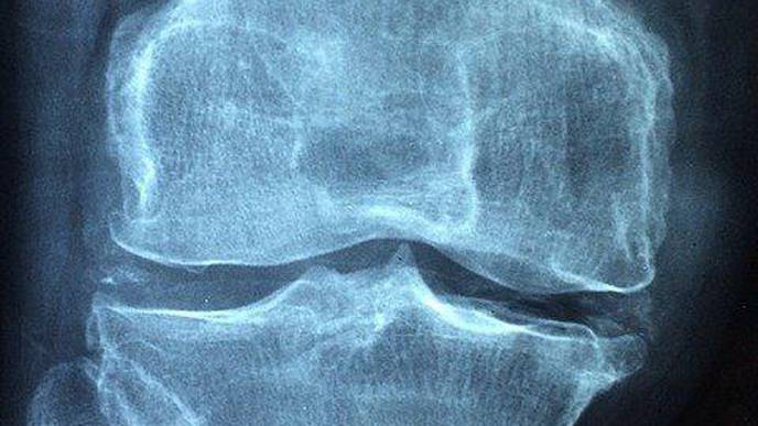 Exercise Prompts Cells to React in a Way That Could Protect Against Bone Cancer & Other Bone-Related Illnesses
