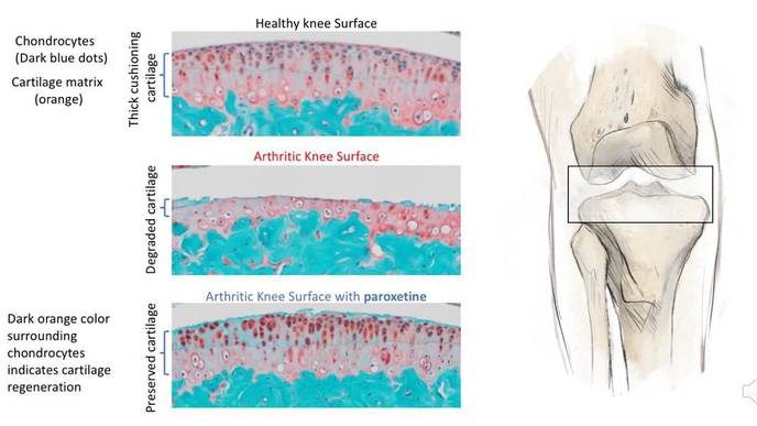 Common Anti-Depressant May Be 1st-Ever Treatment for Osteoarthritis