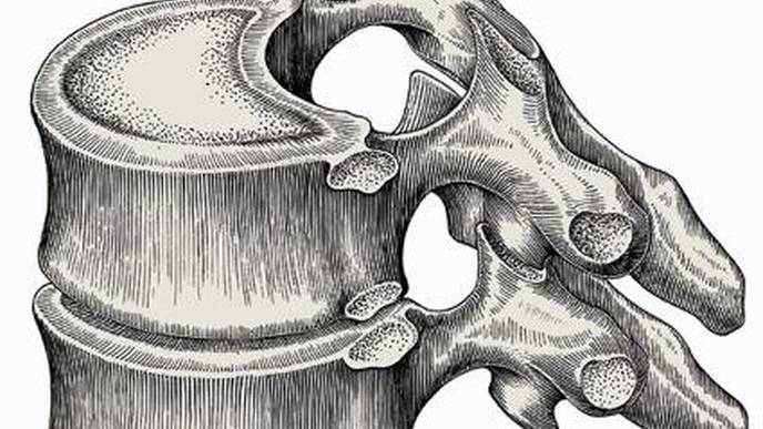 Lumbar Spinal Fusion Surgery Levels Not Linked to Post-Op Opioid Use
