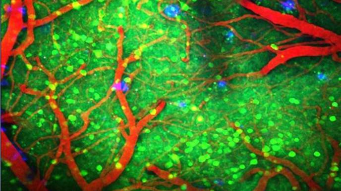 Exploring the Neurological Male-Female Divide in Dementia