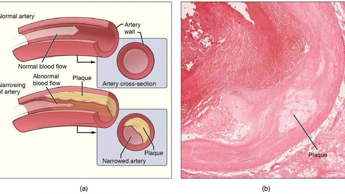 Review: Changing Views on Atherosclerosis