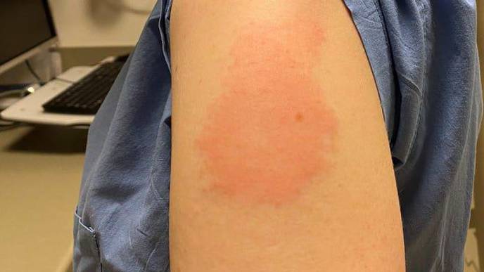 Moderna Vaccine Can Trigger Red, Itchy 'COVID Arm,' But It's Temporary