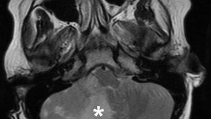 Personalized Drug Screens Could Guide Treatment for Children with Brain Cancer