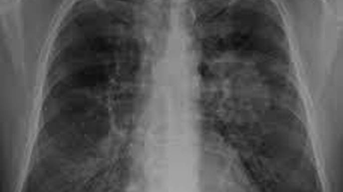 Study Finds COVID-19 Attack on Brain, Not Lungs, Triggers Severe Disease in Mice
