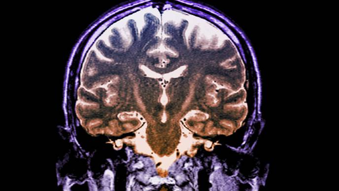 Drug Combo Slows Progression of ALS, Could Mark 'New Era' in Treatment