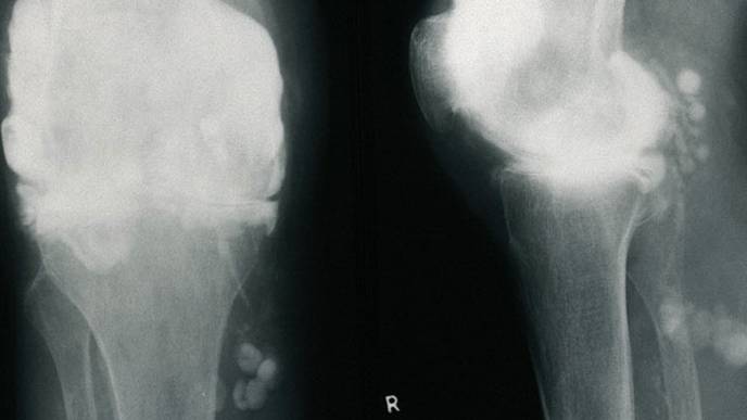 Research Predicts Whether RA Patients Will Respond to Treatment