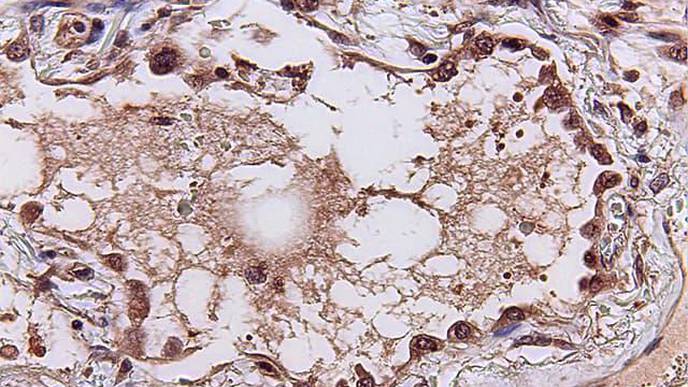 AI Predicts How Patients with COVID-19, Other Infections Will Fare