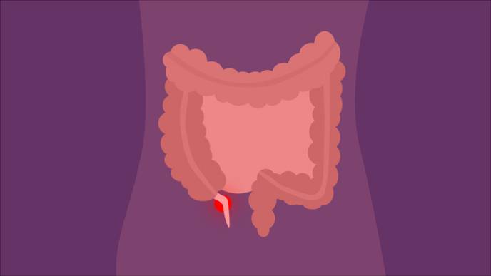 Accurately Diagnosing Appendicitis in the Emergency Department Can Be Challenging