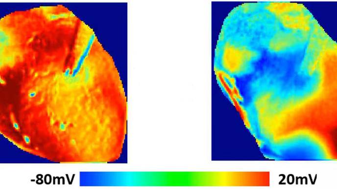 Study Shows Hydroxychloroquine's Harmful Effects on Heart Rhythm