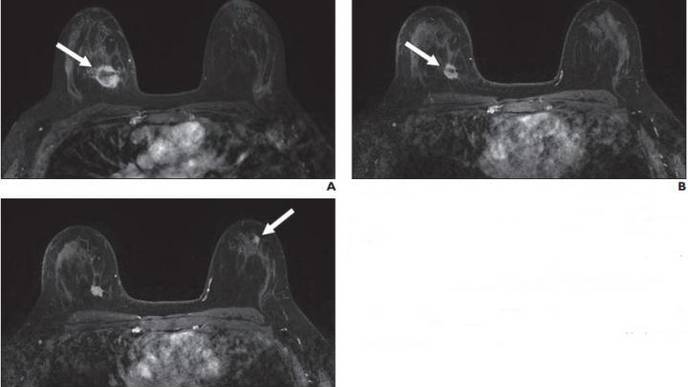 New Suspicious Lesions on Breast MRI in Neoadjuvant Therapy