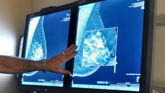 Breast Cancer Care Becomes Troubling Casualty of the Coronavirus