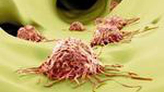 Study Identifies Enzyme Vital to the Metastatic Growth of Prostate Cancer Cells