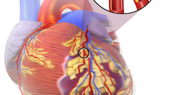 Women Found To Be at Higher Risk for Heart Failure & Heart Attack Death Than Men