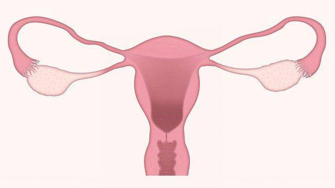 Genetic Analysis Suggests Distinct Subtypes of Polycystic Ovary Syndrome