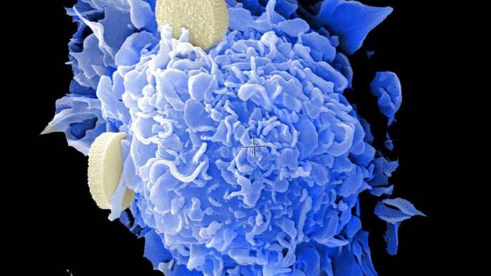 Many Non-Hodgkin’s Lymphoma Patients Can Skip Radiation