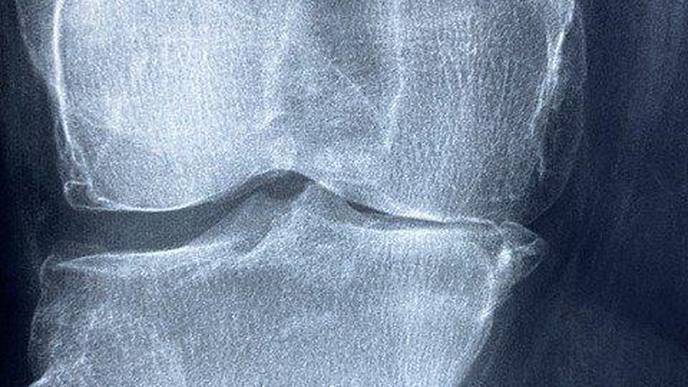 New Interventional Radiology Treatment Relieves Pain, Potentially Decreasing Opiate Use
