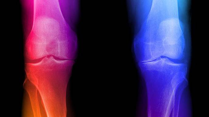 Autologous Chondrocyte Implantation on the Knee: M-ACI Shows Comparable Benefits to Therapeutic Alternatives