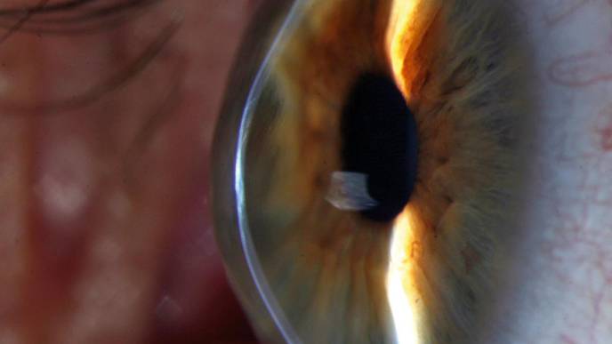 Genetic Study Uncovers Hidden Pieces of Eye Disease Puzzle