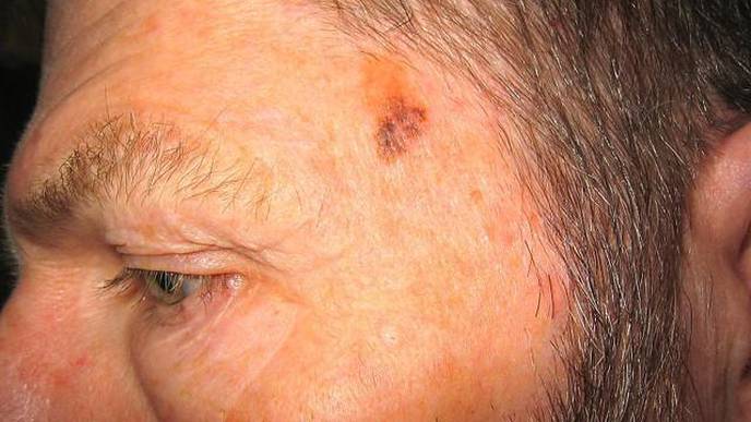 Researchers Find Largest Yearly Declines Ever Recorded in Melanoma Deaths