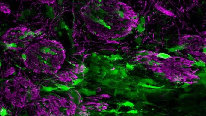 Aggressive Brain Tumors Can Mimic Normal Brain Repair Processes