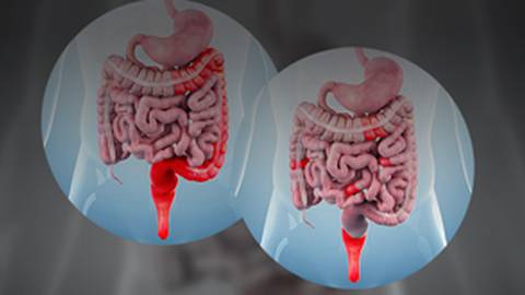 Decision Point IBD: Debating the Factors That Influence Patient-Centric Treatment