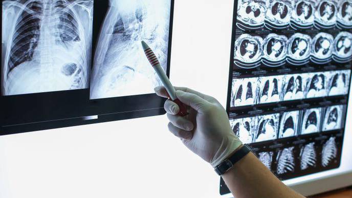 Disparities in Lung Cancer Screening Eligibility Still Exist