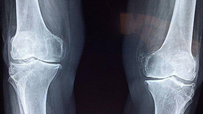 Cognitive Decline May Help Predict Future Fracture Risk in Women