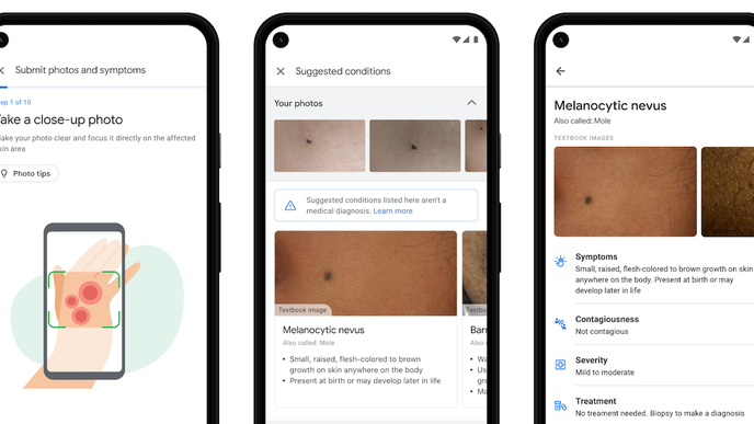 Google Gives a Sneak Peek into Its New AI Dermatology Assistant
