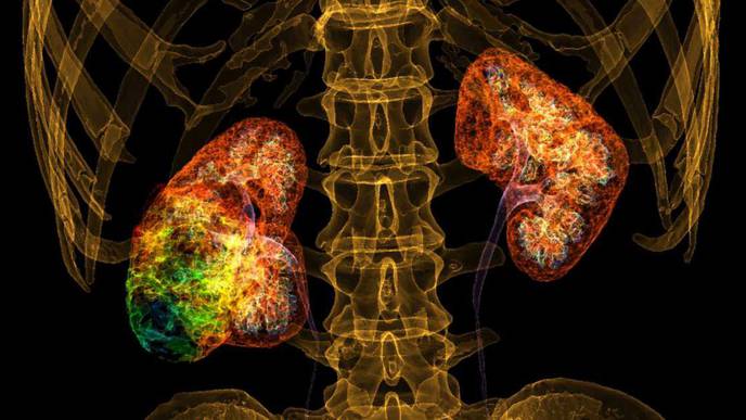 New Hope for Advanced Kidney Cancer Patients