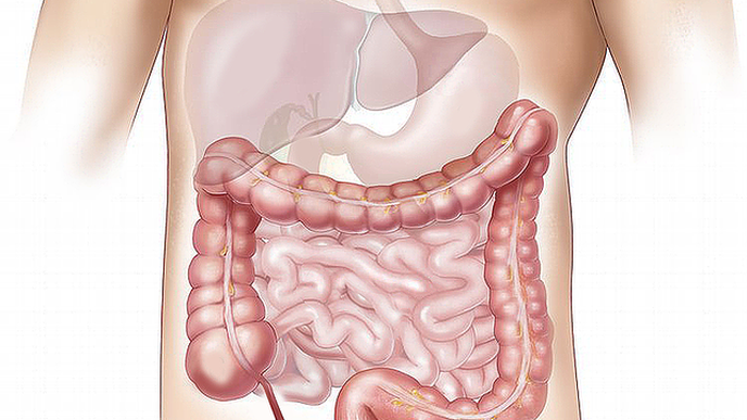 Study Links Leaky Gut to Crohn’s Disease