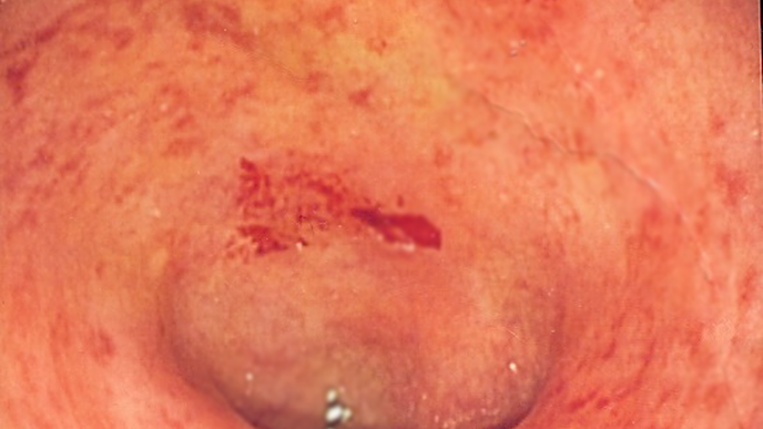 Researchers Identify Enzyme Linked to Colitis