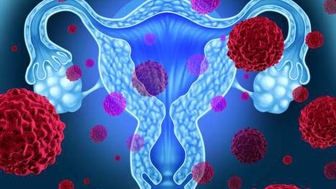 Cervical Cancer: New Radiotherapy Technique Prolongs Survival