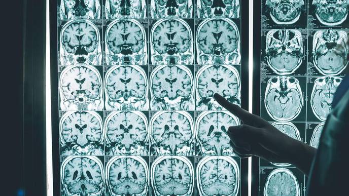 Alzheimer’s Disease: How Precision Medicine Could Reverse Cognitive Decline