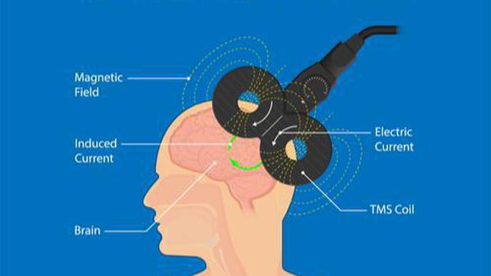 Rewiring Stroke Survivors Brains Could Alleviate Depression