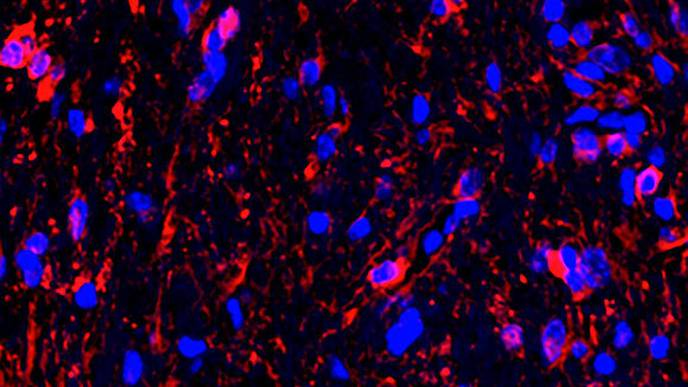 Optic Nerve Firing May Spark Growth of Vision-Threatening Childhood Tumor