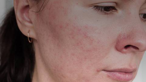 Rethinking the Use of Benzoyl Peroxide for Rosacea Treatment