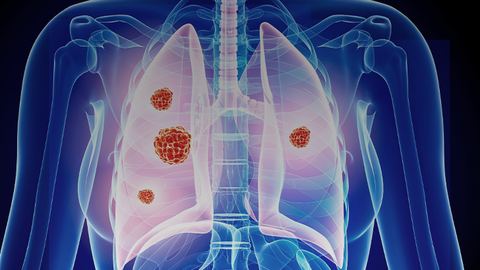 HER3-Directed ADCs in Lung Cancer