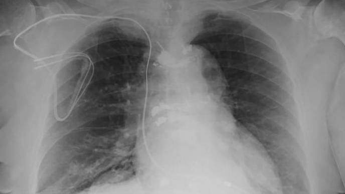 MRI Safely Performed in Patients with Pacemakers & ICDs
