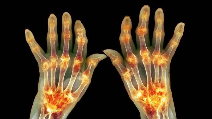 Respiratory Diseases Increase Risk for Rheumatoid Arthritis