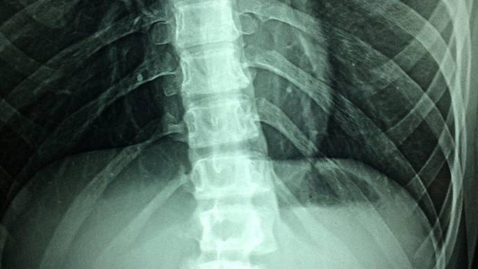 Scientists Repair Injured Spinal Cord Using Patients' Own Stem Cells