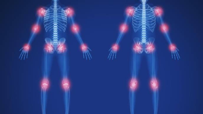 RA Predictors ID'd in Undifferentiated Large Joint Arthritis