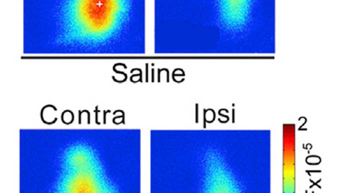 Subanesthetic Ketamine as a Treatment for Lazy Eye