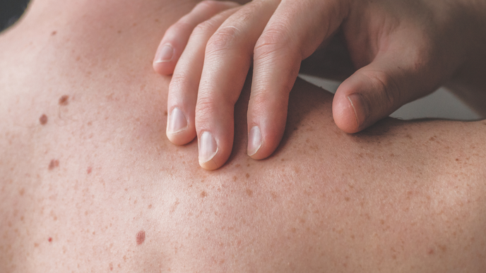 Algorithm That Performs as Accurately as Dermatologists