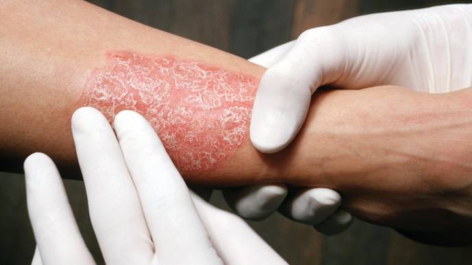 New Recommendations for Use of Biologic Agents in Psoriasis Treatment