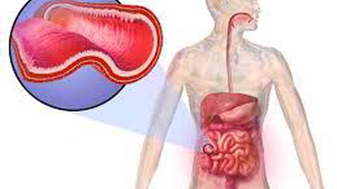 Serious Complication of Crohn’s Disease May Be Preventable in Young People