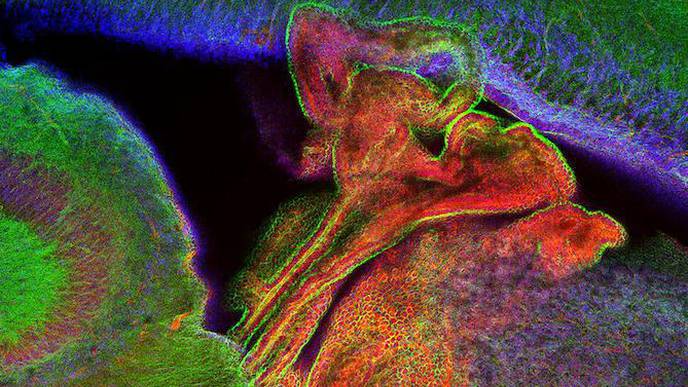 Why Are Newborns So Susceptible to Bacterial Meningitis?