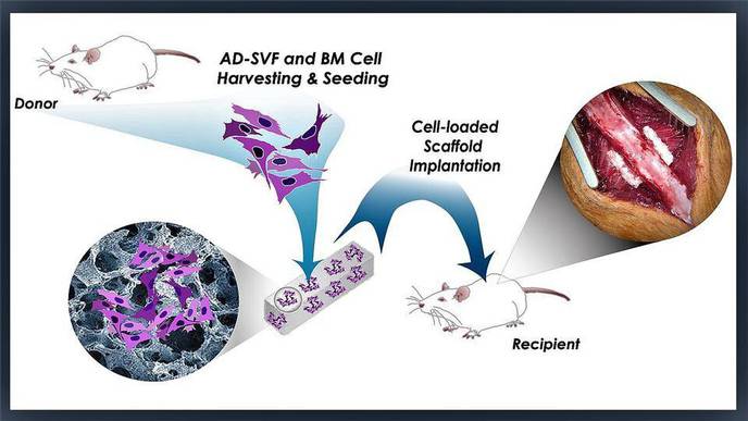Putting Fat to Good Use as Stem Cell Source for Spinal Fusion Surgery